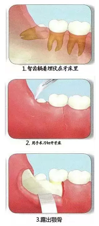 智齒拔除的過程步驟圖片
