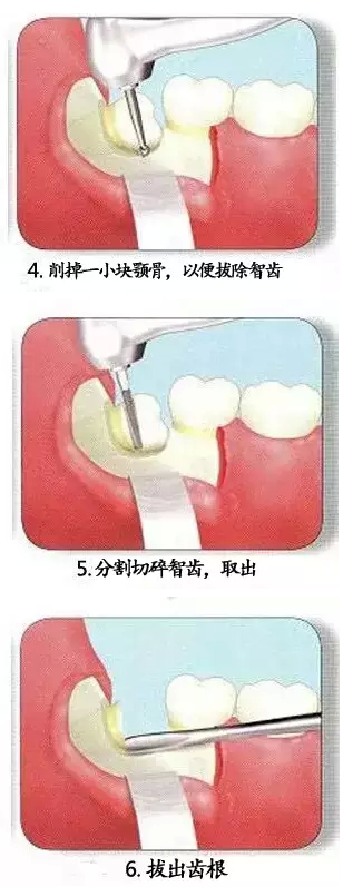 智齒拔除的過程步驟圖片