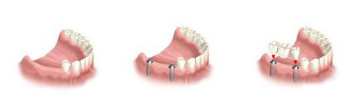 多顆牙種植是怎麽(me) 操作的