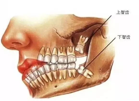 牙齒智齒生長圖片