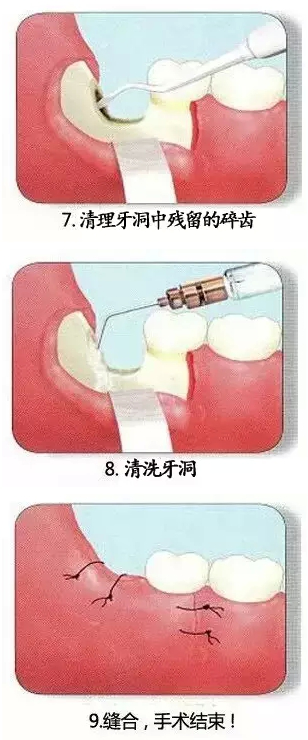 智齒拔出的過程圖片