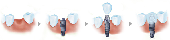  即刻種植牙適合哪些人群？