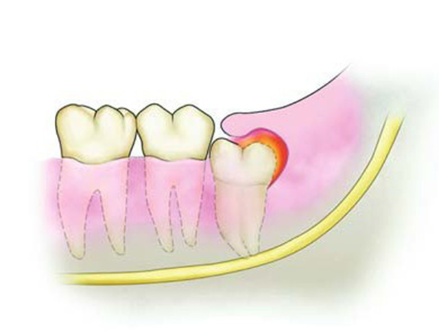 過度疲勞易引發智齒冠周炎