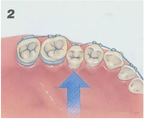 牙齒矯正過程圖解