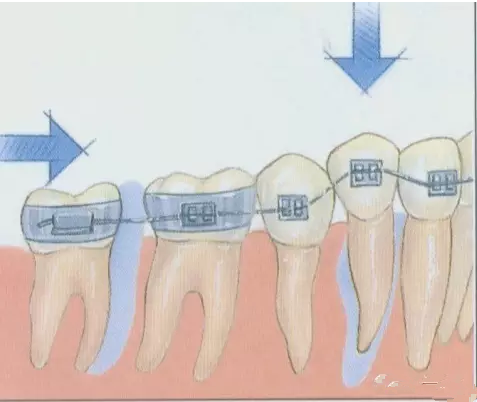 牙齒矯正過程圖解