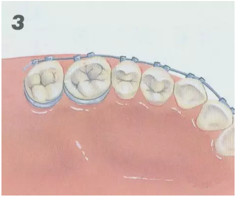 牙齒矯正過程圖解