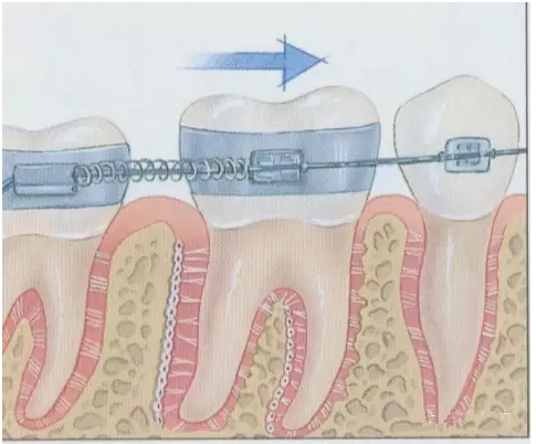 牙齒矯正過程圖解
