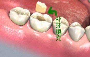 深圳補的牙可以保持多長時間