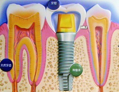 蛀牙齲齒種植牙好不好?