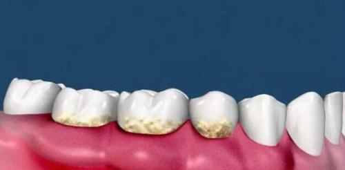 為(wei) 什麽(me) 要洗牙,洗牙的好處,洗牙,洗牙的過程,洗牙後的注意事項