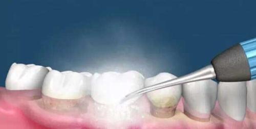 為(wei) 什麽(me) 要洗牙,洗牙的好處,洗牙,洗牙的過程,洗牙後的注意事項