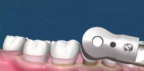 為(wei) 什麽(me) 要洗牙,洗牙的好處,洗牙,洗牙的過程,洗牙後的注意事項