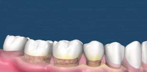 為(wei) 什麽(me) 要洗牙,洗牙的好處,洗牙,洗牙的過程,洗牙後的注意事項