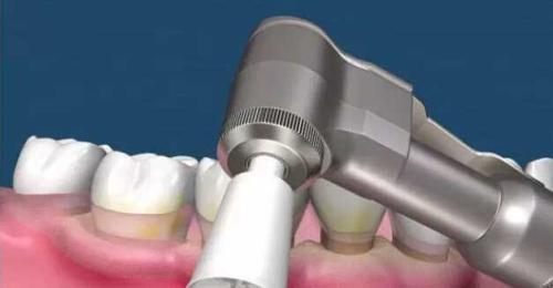 為(wei) 什麽(me) 要洗牙,洗牙的好處,洗牙,洗牙的過程,洗牙後的注意事項