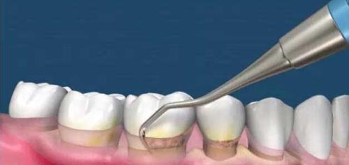 為(wei) 什麽(me) 要洗牙,洗牙的好處,洗牙,洗牙的過程,洗牙後的注意事項