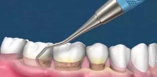 為(wei) 什麽(me) 要洗牙,洗牙的好處,洗牙,洗牙的過程,洗牙後的注意事項