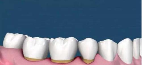 為(wei) 什麽(me) 要洗牙,洗牙的好處,洗牙,洗牙的過程,洗牙後的注意事項