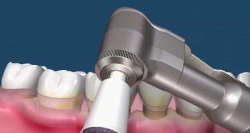 為(wei) 什麽(me) 要洗牙,洗牙的好處,洗牙,洗牙的過程,洗牙後的注意事項