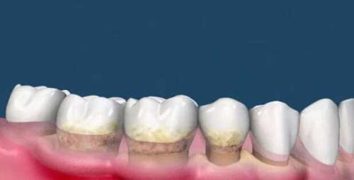 為(wei) 什麽(me) 要洗牙,洗牙的好處,洗牙,洗牙的過程,洗牙後的注意事項