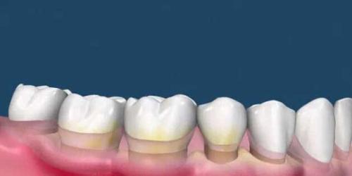 為(wei) 什麽(me) 要洗牙,洗牙的好處,洗牙,洗牙的過程,洗牙後的注意事項