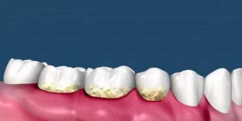 為(wei) 什麽(me) 要洗牙,洗牙的好處,洗牙,洗牙的過程,洗牙後的注意事項