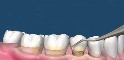 為(wei) 什麽(me) 要洗牙,洗牙的好處,洗牙,洗牙的過程,洗牙後的注意事項