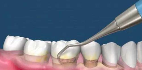 為(wei) 什麽(me) 要洗牙,洗牙的好處,洗牙,洗牙的過程,洗牙後的注意事項