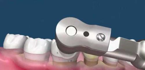 為(wei) 什麽(me) 要洗牙,洗牙的好處,洗牙,洗牙的過程,洗牙後的注意事項