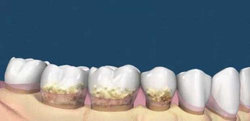 為(wei) 什麽(me) 要洗牙,洗牙的好處,洗牙,洗牙的過程,洗牙後的注意事項