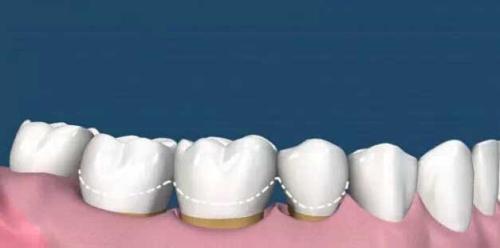 為(wei) 什麽(me) 要洗牙,洗牙的好處,洗牙,洗牙的過程,洗牙後的注意事項