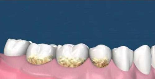為(wei) 什麽(me) 要洗牙,洗牙的好處,洗牙,洗牙的過程,洗牙後的注意事項