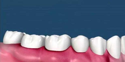 為(wei) 什麽(me) 要洗牙,洗牙的好處,洗牙,洗牙的過程,洗牙後的注意事項