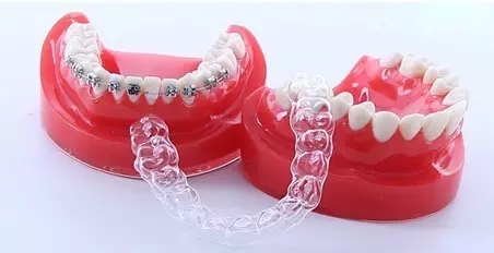 牙齒正畸治療後佩戴保持器，注意口腔衛生