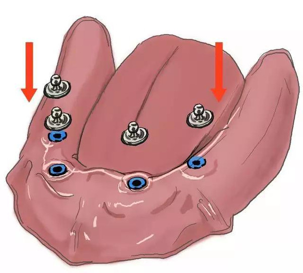 傳(chuan) 統鑲牙和種植牙的區別