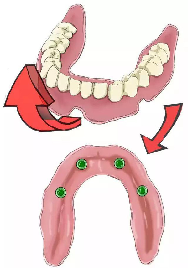 傳(chuan) 統鑲牙和種植牙的區別