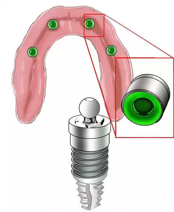傳(chuan) 統鑲牙和種植牙的區別