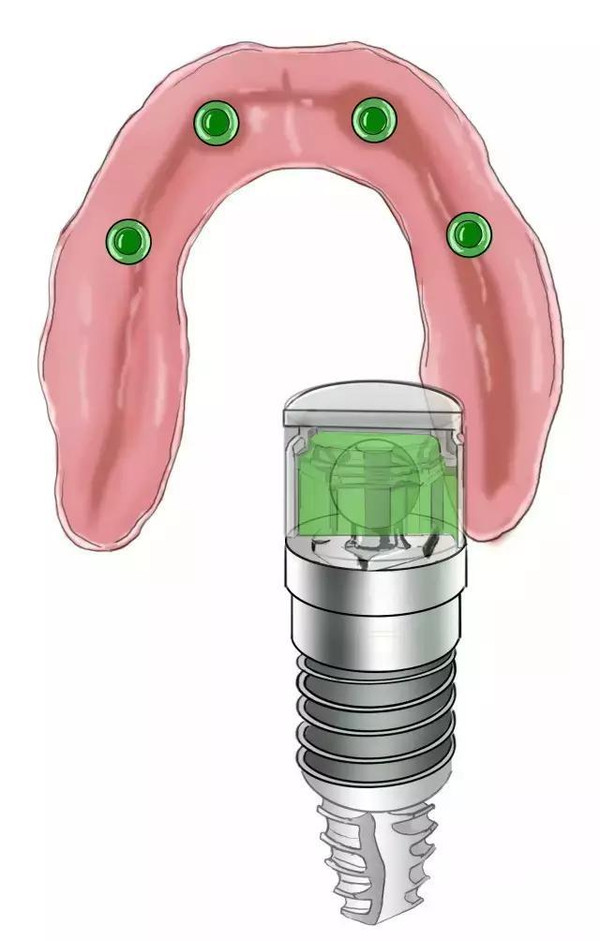 傳(chuan) 統鑲牙和種植牙的區別