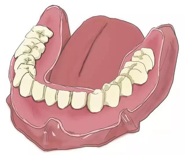 傳(chuan) 統鑲牙和種植牙的區別