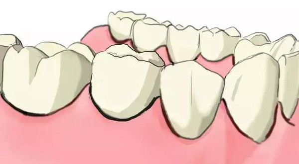 傳(chuan) 統鑲牙和種植牙的區別