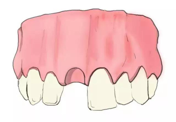 傳(chuan) 統鑲牙和種植牙的區別