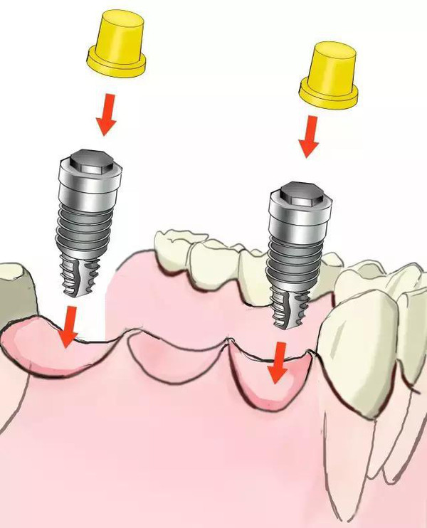 傳(chuan) 統鑲牙和種植牙的區別