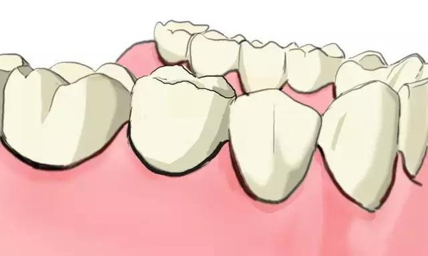 傳(chuan) 統鑲牙和種植牙的區別