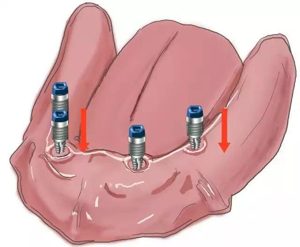傳(chuan) 統鑲牙和種植牙的區別