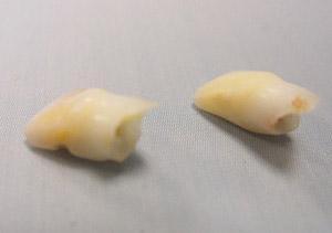 拔牙沒有你想的那麽(me) 簡單