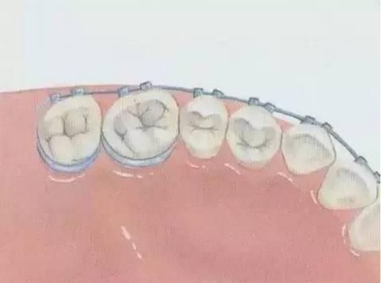 牙套矯正牙齒