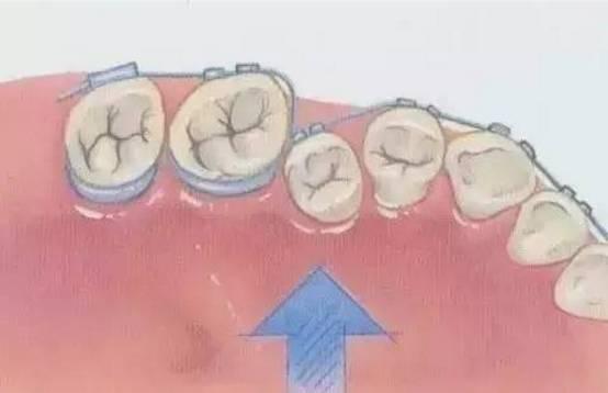牙套矯正牙齒