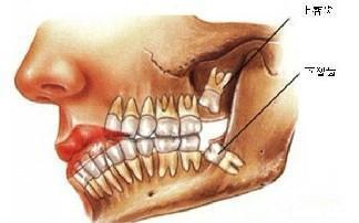 牙齒鬆動一定要拔牙嗎