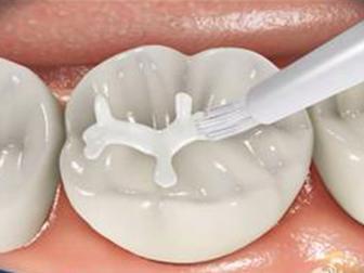 預防齲齒較經濟較有效的方法是窩溝封閉