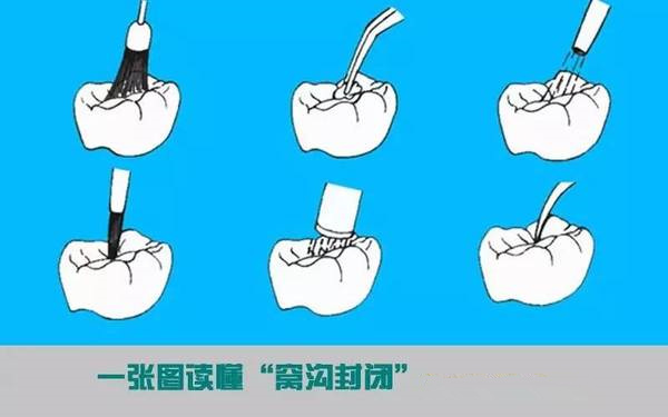窩溝封閉護理“竅門