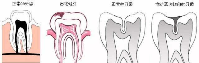 為(wei) 什麽(me) 孩子要做窩溝封閉呢?
